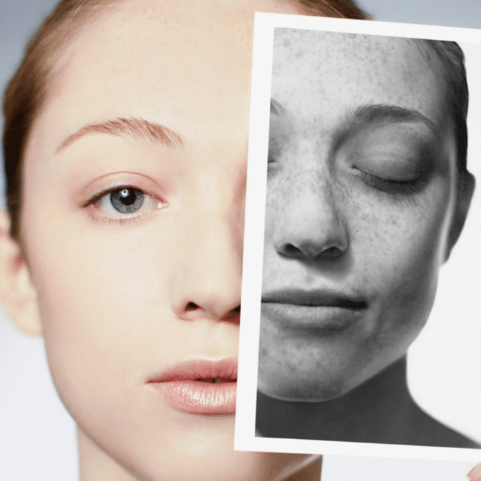 Voor en na de depigmentatiebehandeling die een aanzienlijke verbetering van de huidtint laat zien.