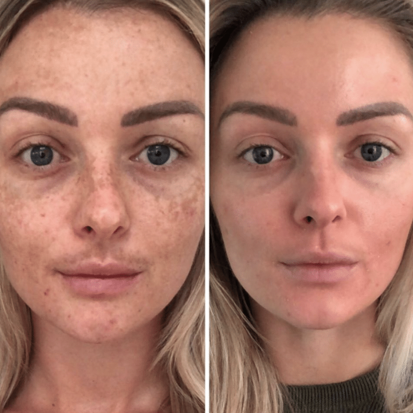 Voor en na de depigmentatie behandeling die een verbetering van de huidskleur laat zien.