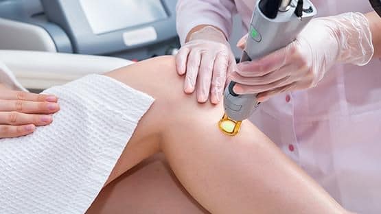 Laserontharingsbehandeling op het been van een vrouw in een klinische omgeving.