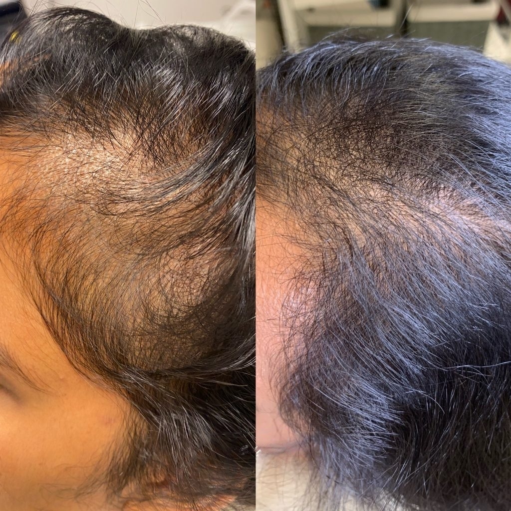 Mesotherapie behandeling voor en na