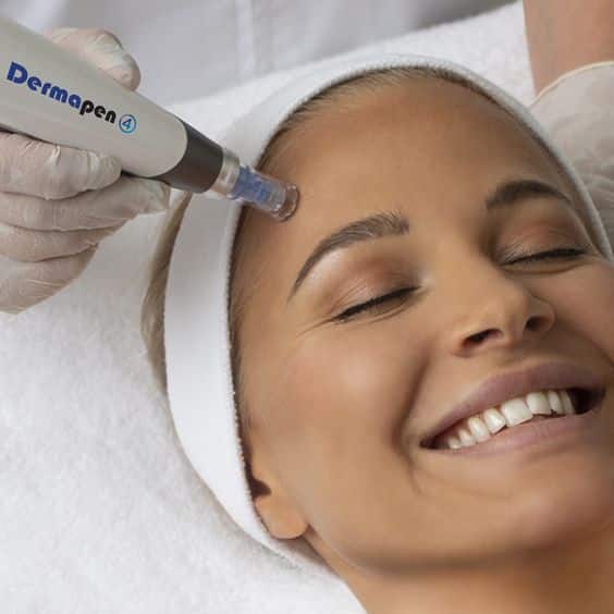 Close-up van microneedling behandeling op de gezichtshuid.
