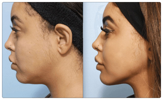 Onderkin weghalen voor en na